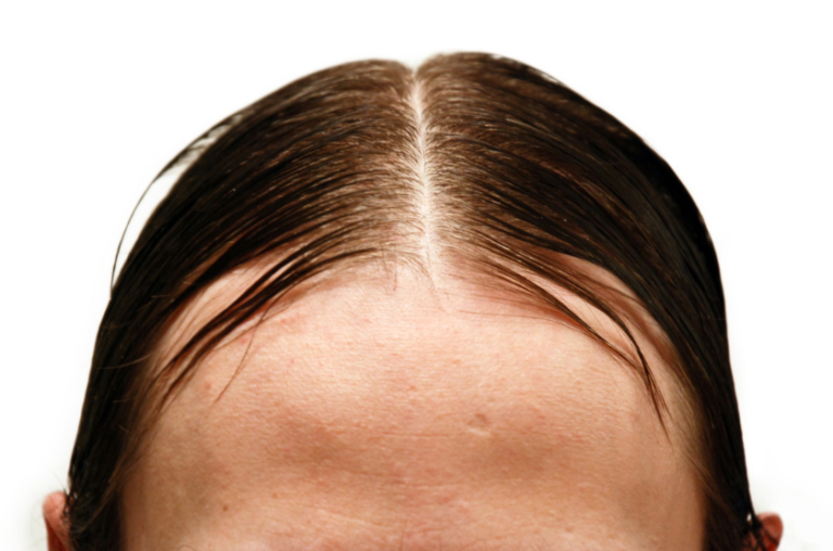 cheveux gras séparés par une raie au milieu